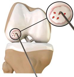 Chondroplasty