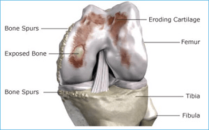 Conformis Knee