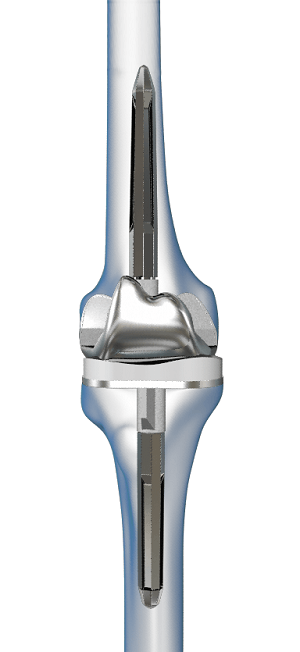 Correction of a Failed Knee Replacement