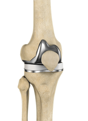 Correction of a Painful Knee Replacement