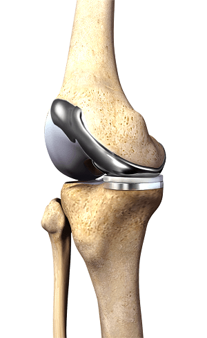 Custom Knee Replacement