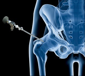 Hip Arthroscopy