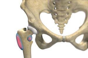 Hip Bursitis Treatment in Knoxville