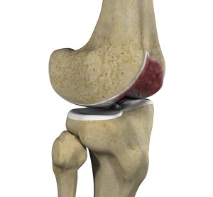 Knee Arthritis