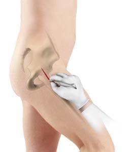 Minimally Invasive Knee Joint Replacement