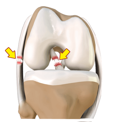 Multiligament Knee Injuries