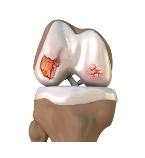 Osteoarthritis Management