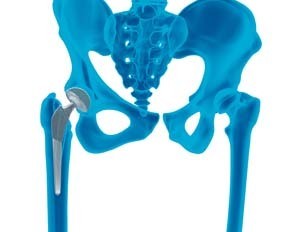 Outpatient Anterior Approach Hip Replacement
