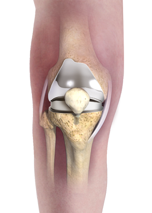 Patient Specific Knee Replacement