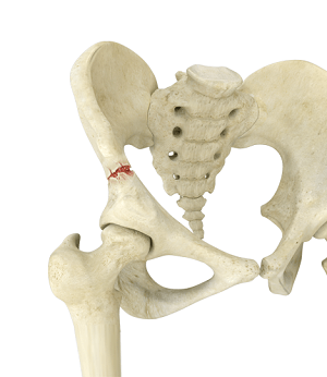 Pelvic Fractures