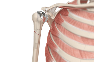 Periprosthetic Shoulder Fracture