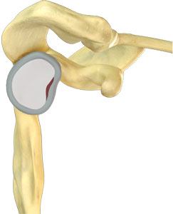 Shoulder Labral Tear