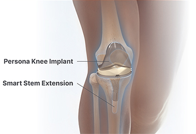 Persona Knee Implants